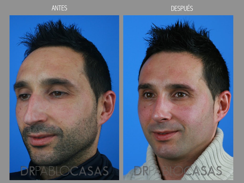 rinoplastia